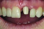 Figure 12 After sintering, the e.max abutment was tried in the mouth and torqued to 30 Ncm.