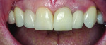 Figure 13 The fi nal e.max crown was cemented using Multilink® composite cement (Ivoclar Vivadent). Note the translucency of the implant restoration on No. 9 compared to the patient’s natural tooth No. 8. The gingiva will continue to mature over time.