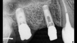 Figure 5 Abutments contoured to a concave,
gingivally converging transmucosal profile were incorporated into a screw-retained provisional. Radiograph demonstrated passive fit with one-screw test.