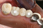 Figure 7 Occlusal access sealed with silicone temporary material.