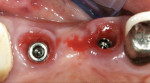 Figure 3 Upon abutment removal, severe hypertrophy, erythema, and necrosis of gingival collars was discovered.