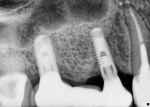 Figure 11 Control radiograph demonstrating replication of undercontoured abutments in the definitive prosthesis.