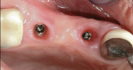 Figure 8 and Figure 9 Two weeks after abutment modification there was a dramatic improvement in gingival tone (Fig 8), and transmucosal tissue was fully healed with healthy adaptation to the new abutments (Fig 9).