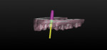 Figure 7 Virtual view of the abutment superimposed on the optically scanned
cast during the laboratory design process.