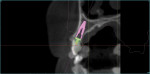 Figure 4 Conebeam computed tomographic cross-section showing degree of correction
required from existing axis of tooth No. H. Optimal thickness of bone at the alveolar crest is evident.