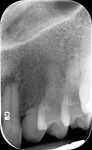 Figure 2 Radiographic view of proposed implant site, showing completely resorbed root on tooth No. H and moderate resorption on apex of tooth No. 10.