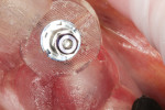 Figure 12 Guide-compatible implant mount after insertion of implant to appropriate depth through the surgical guide.