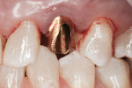 Figure 16 Immediate postsurgical view of abutment seated to implant platform.