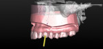 Figure 3 Digital image of optically scanned maxillary diagnostic cast, with virtually designed replacement tooth and proposed axis.