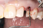 Figure 13 Running-room depth between free gingival margin and fully inserted implant platform, measured with a UNC-15 periodontal probe.