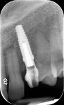 Figure 17 Periapical radiograph verifying seating of all implant components.