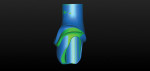 Figure 26 Coronal views of the initial (green) and revised (blue) CAD/CAM patient-specific virtual abutment and associated margin designs interfaced.