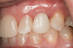 Figure 28 Post-cementation view of final crown.