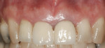 Figure 1 Pretreatment photograph showing a square tooth form and thick biotype with the gingival margins of the central incisors more coronal to the lateral incisors.
