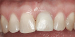 Figure 6 Three months
after surgery, the central incisor gingival levels were nearly even.
