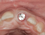 Figure 5 Incisal view of the left central incisor after implant placement but prior to placement of the provisional on the same day.