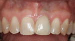 Figure 7 Two years after surgery, there was a 2-mm discrepancy in gingival levels and a dark gingival appearance.