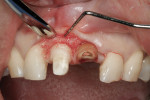 Figure 9 Prior to extraction of the left central incisor and osseous recontouring/crown lengthening on the right central incisor.