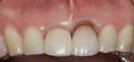 Figure 8 Pretreatment photograph of the central incisors showing gingival asymmetry; the left central incisor was diagnosed as having vertical root fracture.