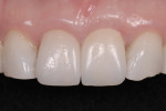 Figure 15 Final restorations. (Restorative dentistry performed by Greggory Kinzer, DDS, Seattle, Washington.)