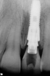 Figure 20 Radiograph of immediate implant and
screw-retained provisional.