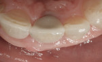 Figure 23 Incisal view at 2 years demonstrating the stability of the SCTG and facial volume.