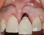 Figure 18 Trying in screw-retained provisional.
