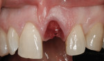 Figure 17 After extraction of left central incisor, prior to split thickness tunnel flap elevation.