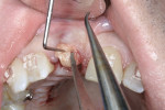 Figure 24 Placement of a small SCTG into the facial peri-implant cervical area.