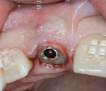 Figure 25 Autogenous SCTG was seen facial to the custom healing abutment.