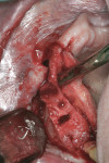 Figure 1 Advanced resorbed maxilla before
bone grafting.