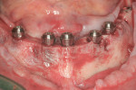Figure 6 After implant placement in the thin alveolar ridge following planing of the bone to create space for the restoration, the implants are shown in situ after connection with multi-base abutments.