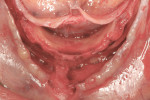 Figure 5 Extreme atrophic mandible after elevation of a mucoperiosteal flap.