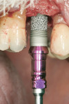 Figure 27 Immediate implant with a tantalum core in the middle of the implant for improvement of the biological stability after osteotome technique (internal sinus lift).