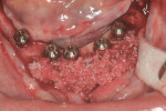 Figure 7 Lateral ridge augmentation with particulated bone.