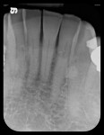 Figure 6 Five radiographs taken with flexible phosphor sensors despite the patient’s severely restricted ability to open his mouth. Right-side bitewing (Fig 4). Left-side bitewing (Fig 5).
Mandibular anteriors (Fig 6). Maxillary anteriors (Fig 7). Maxillary right premolar/molar area (Fig 8).