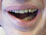 Figure 3 Maximum opening for patient with restricted ability to open wide on right side.