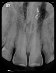 Figure 7 Five radiographs taken with flexible phosphor sensors despite the patient’s severely restricted ability to open his mouth. Right-side bitewing (Fig 4). Left-side bitewing (Fig 5).
Mandibular anteriors (Fig 6). Maxillary anteriors (Fig 7). Maxillary right premolar/molar area (Fig 8).