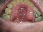 Figure 9 Intraoral camera image of severe bilateral mandibular tori.