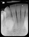 Figure 10 Flexible phosphor sensor radiograph of mandibular tori.