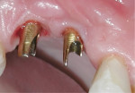 Figure 6 The abutments hand-tightened in the mouth.