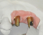 Figure 4 The abutments on the soft-tissue model from the laboratory.