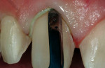 Figure 1  The #0 cord is placed in the gingival sulcus. Note that the blade of the instrument is parallel with and aligned against the root surface while exerting apical pressure to prevent tearing the free gingival tissue.
