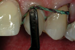 Figure 3  The #1 cord is shown during placement. It should be totally visible from the occlusal view for complete tissue displacement.