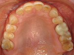 Figure 2 and Figure 3. Maxillary and mandibular arch at initial presentation; note the areas of moderate attrition and dentin displaying tooth loss from erosion.