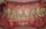 Retracted view of the patient in maximum intercuspal position (MIP) at initial presentation. Note the visible crown margins on her previous restorations and the worn and chipped
edges of her maxillary incisors.