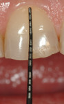 Figure 6. With an 8-mm central at initial presentation, the restorative dentist is comfortable prescribing a 10.5-mm central in the final prosthesis, which adds to the tooth display in repose and keeps the tooth size within expected norms.