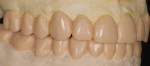 Figure 8. With the diagnostic wax-up completed, a template for the final restorations has been created that can be used to demonstrate the dentist’s vision for the permanent restorations to the patient, to fabricate the provisional restorations, and to provide a guide for tooth preparation.