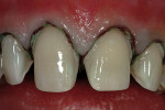 Figure 4  Retraction cords in place before removal for the registration of the master impression.