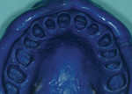 Figures 9 and 10. Maxillary final impression made using the dual-cord technique and a polyether material. Note the impression has captured close to 1 mm apical to the restoration margin, which communicates emergence profile.